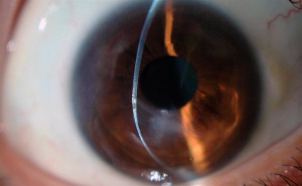 El queratocono es la primera causa de trasplante corneal en jóvenes, según expertos