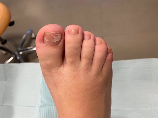 Los podólogos advierten de que los esmaltes permanentes pueden causar hongos en las uñas de los pies