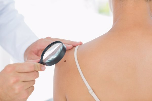 Roche lanza la campaña '#TuPielImporta' para concienciar sobre el cáncer de piel