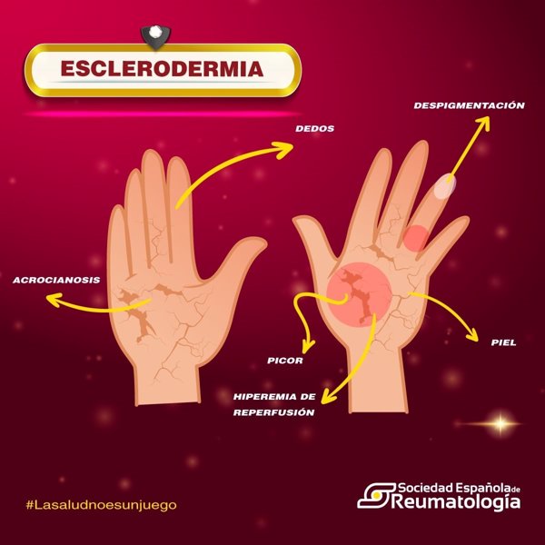 Experta destaca que la supervivencia a cinco años en esclerodermia ha mejorado en un 90% en la última década