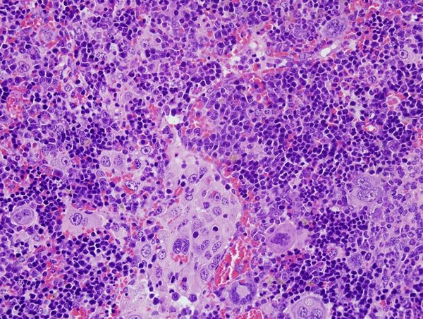 Investigadores del CSIC identifican mutaciones en un gen vinculadas al desarrollo de linfomas