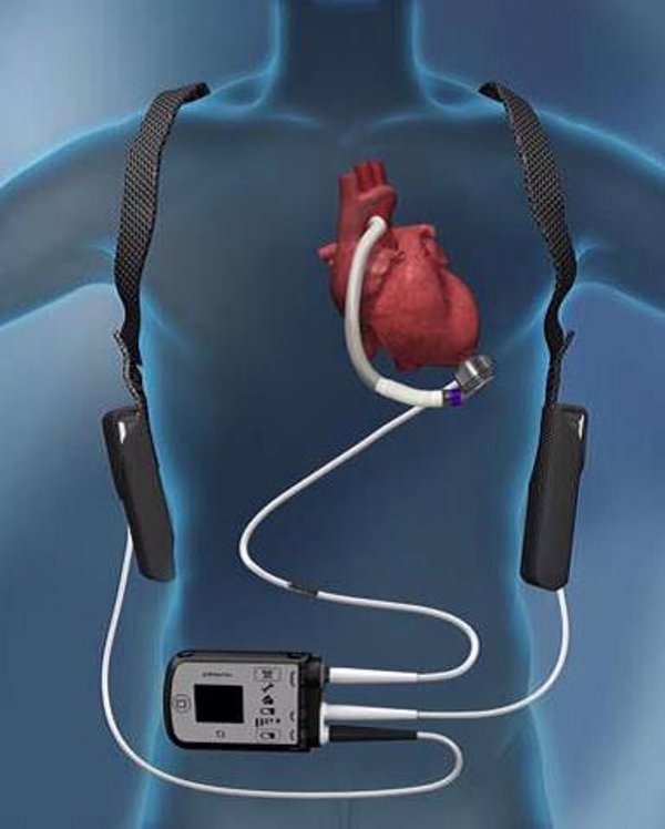El Hospital La Fe (Valencia) implanta el dispositivo de asistencia cardíaca 