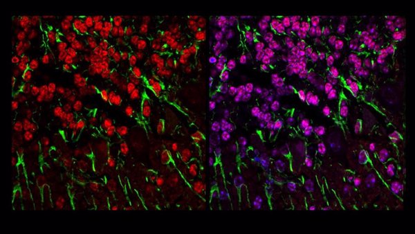 Descubren una posible diana terapéutica para frenar la degeneración neuronal en la enfermedad de Batten