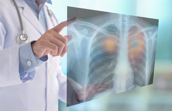 La radioterapia dirigida puede ser eficaz en cáncer de pulmón de células pequeñas con metástasis cerebrales