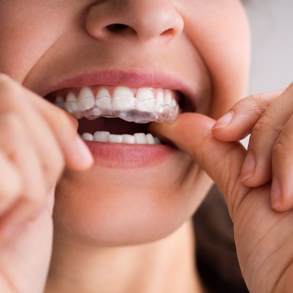 Sanidad recuerda que no deben realizarse compras 'on line' de aparatos como alineadores dentales invisibles