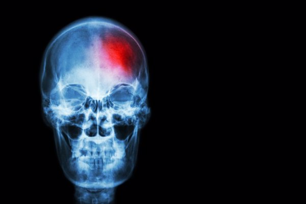 El trabajo por turnos aumenta la gravedad de los ictus, según un estudio