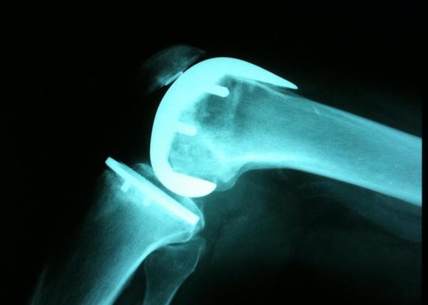 Expertos aseguran que el pronóstico de los pacientes con artrosis de rodilla se puede predecir