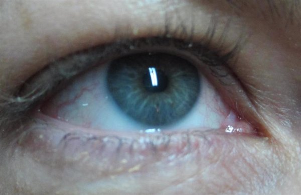 AUVEA impulsa el Día Mundial de la Uveítis con el fin de dar visibilidad a esta enfermedad rara ocular