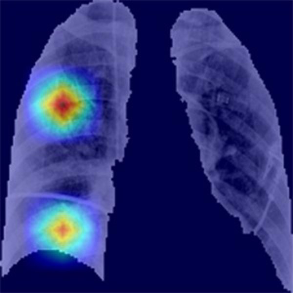 Un estudio revela el alcance del daño pulmonar residual tras la hospitalización por COVID-19