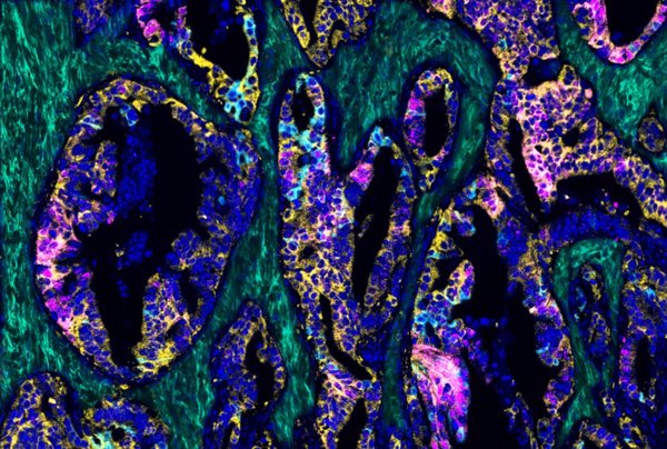 Investigadores españoles identifican una posible terapia contra el cáncer de colon metastásico