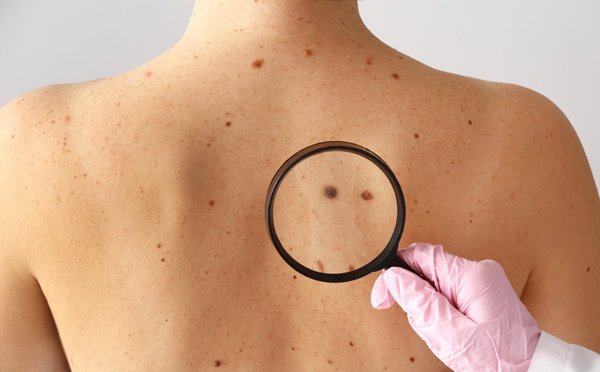 Un estudio consigue bloquear el cáncer de piel utilizando piel humana artificial