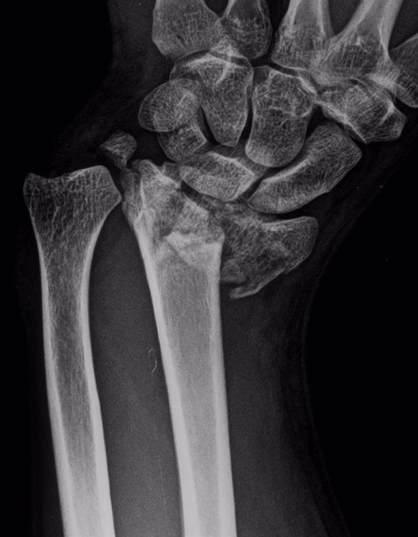 Experta destaca la importancia de diagnosticar y tratar de forma urgente las fracturas para una adecuada recuperación