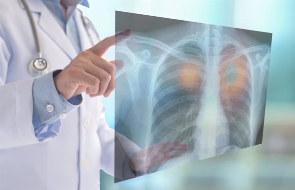 La supervivencia de los pacientes con fibrosis pulmonar idiopática es de 2 a 5 años sin tratamiento, según expertos