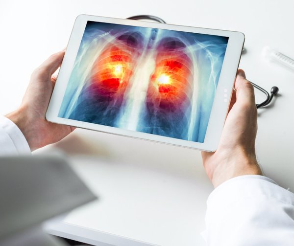 La Asociación para la Investigación de Cáncer de Pulmón en Mujeres advierte de que el gas radón es 