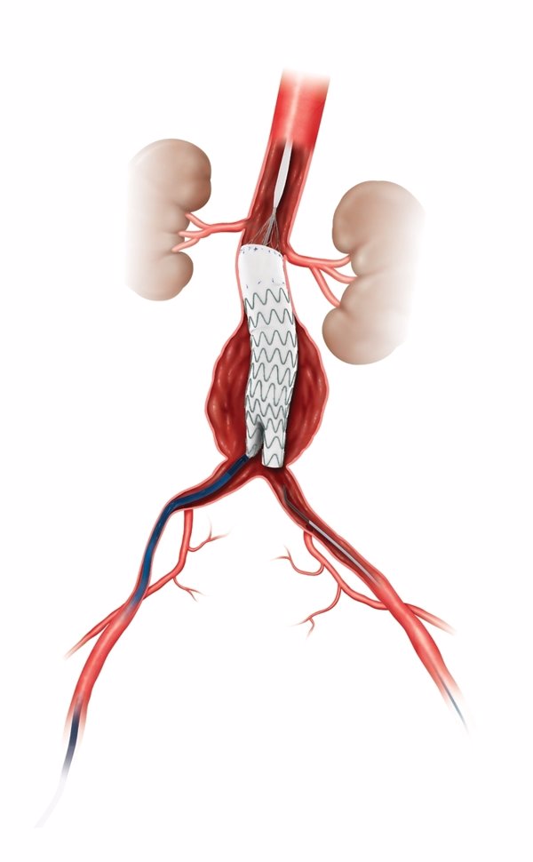 Una tesis doctoral desarrolla un tratamiento pionero para la disección aórtica