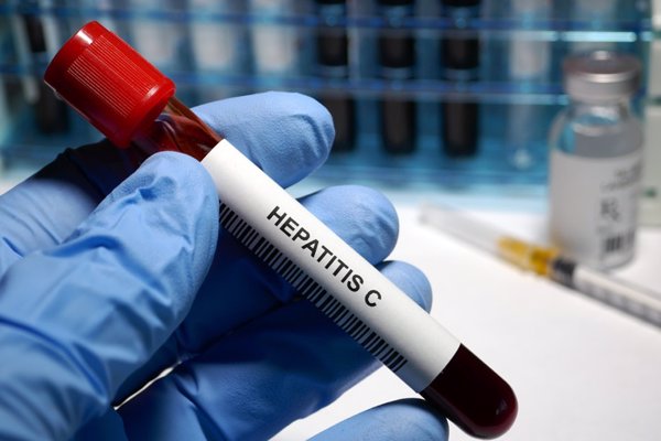 El grado de cirrosis hepática está ligado al microbioma sanguíneo en pacientes con hepatitis C, según el ISCIII