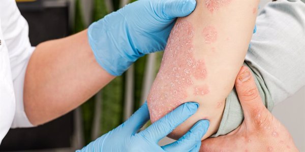 Un 45% de los pacientes con psoriasis moderada-grave tiene placas de ateroma en las arterias femorales