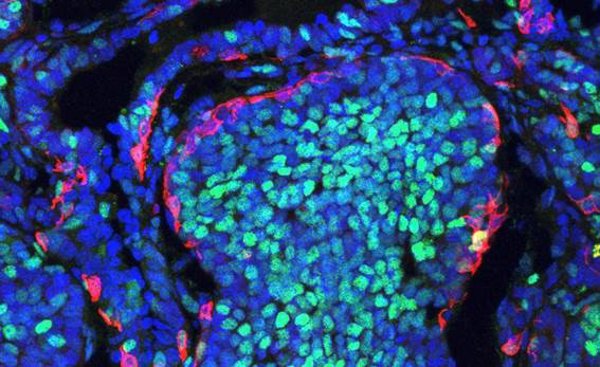 Un nuevo estudio revela que las células cancerosas compiten a favor y en contra del desarrollo del tumor