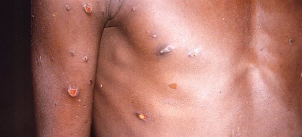 El número de casos de mpox en África muestra una tendencia al alza, según la OMS