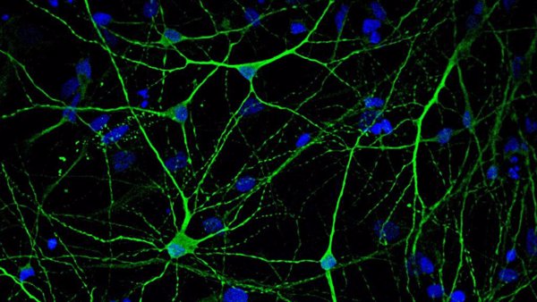 La distribución de un receptor clave para la memoria en cerebros con Alzheimer empeora la enfermedad, según un estudio