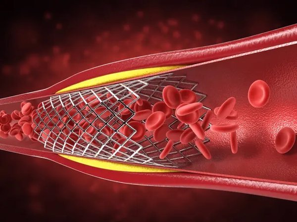 Un stent polimérico desarrollado por investigadores de IQS recibe un premio internacional en innovación pediátrica