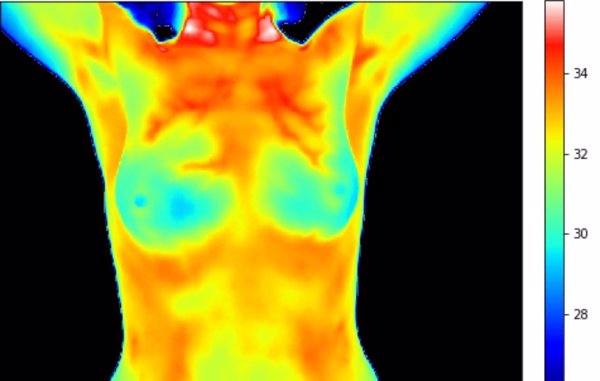 La UNED estudia el potencial de la termografía para la detección de cáncer de mama