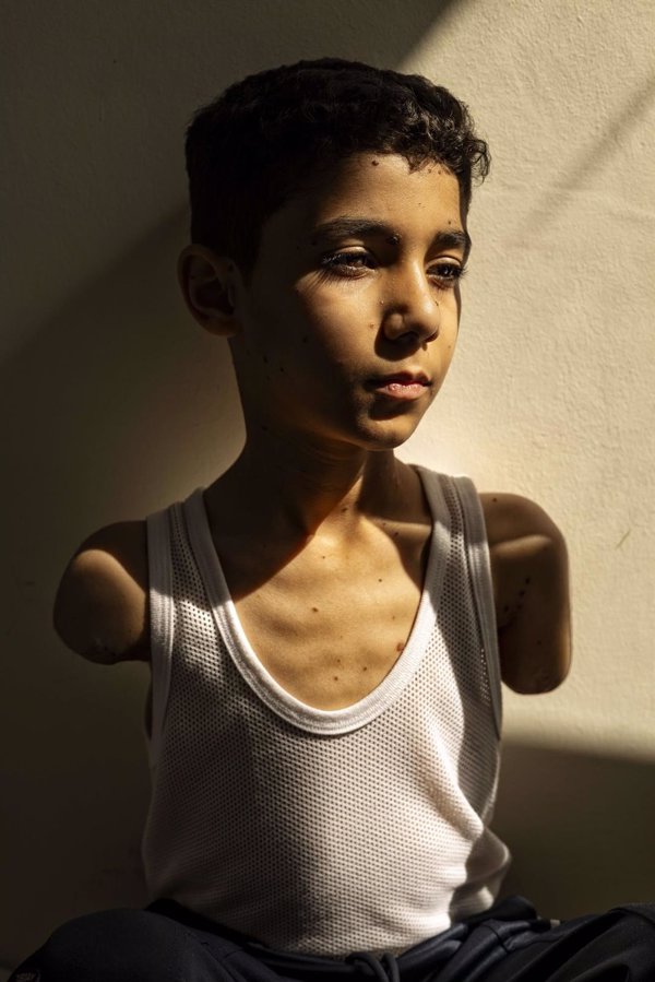 La imagen de un niño mutilado en un ataque de Israel sobre Gaza, foto del año del World Press Photo 2025