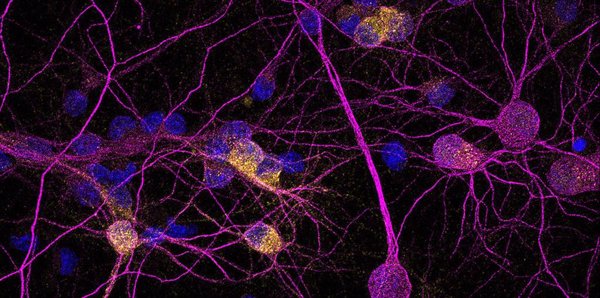 Identifican una proteína que podría mejorar la supervivencia de las neuronas en la enfermedad de Huntington