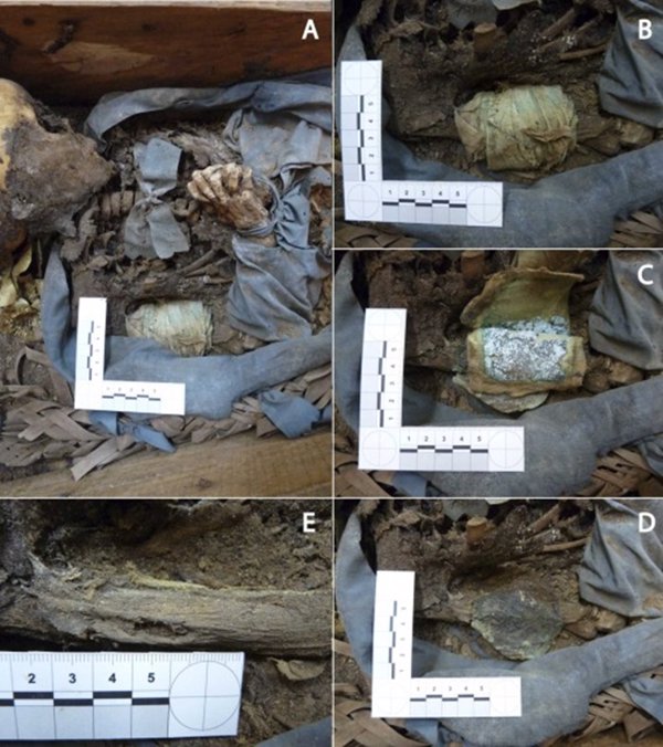 Una investigación desvela cómo se trataba la enfermedad y el ritual funerario en el siglo XIX en Madrid