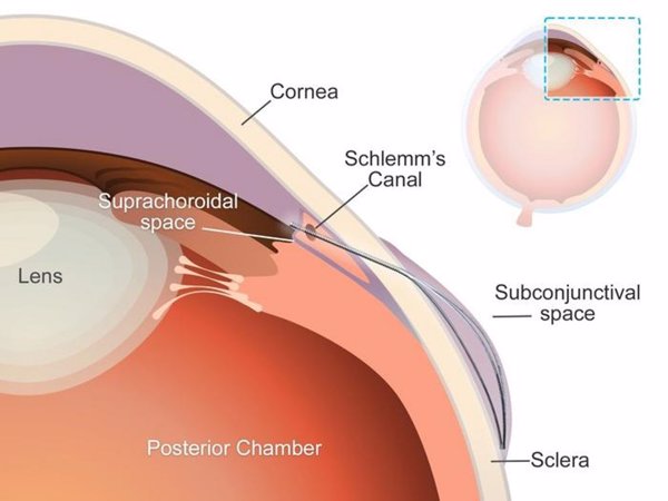 Desarrollan un 'microstent' con una forma única para combatir el glaucoma